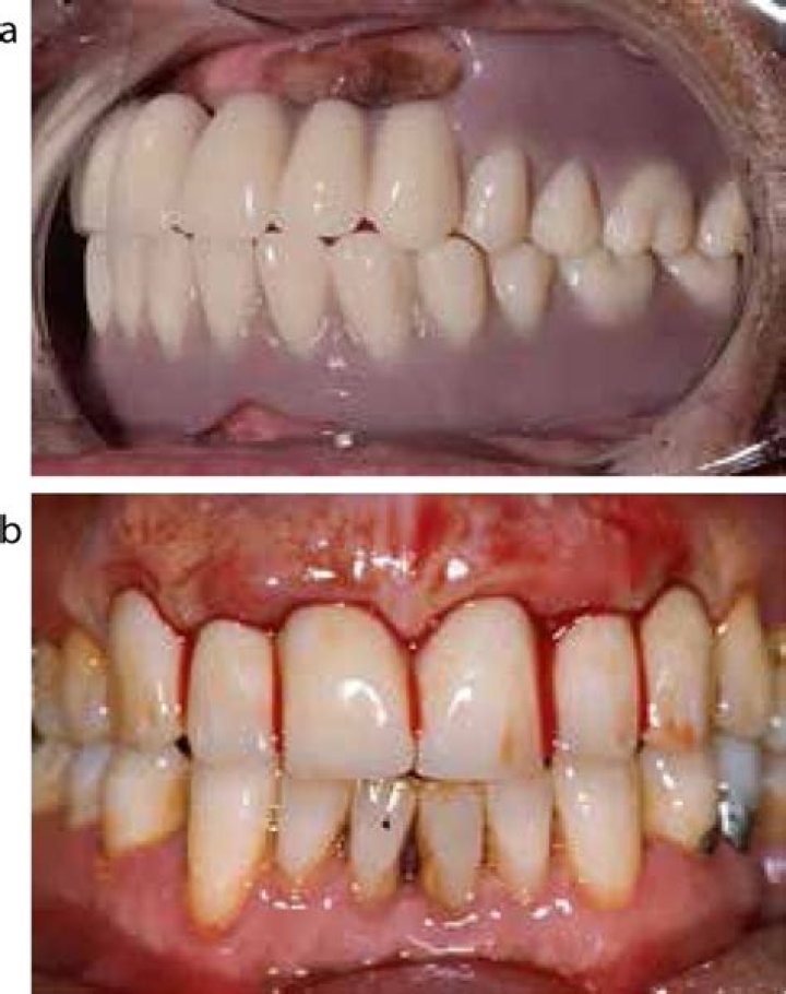 Embracing Day 3 With Immediate Dentures