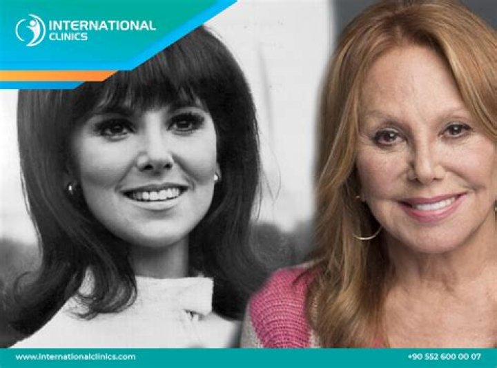 Unveiling Marlo Thomas's Face Surgery Journey: Surprising Insights And Discoveries